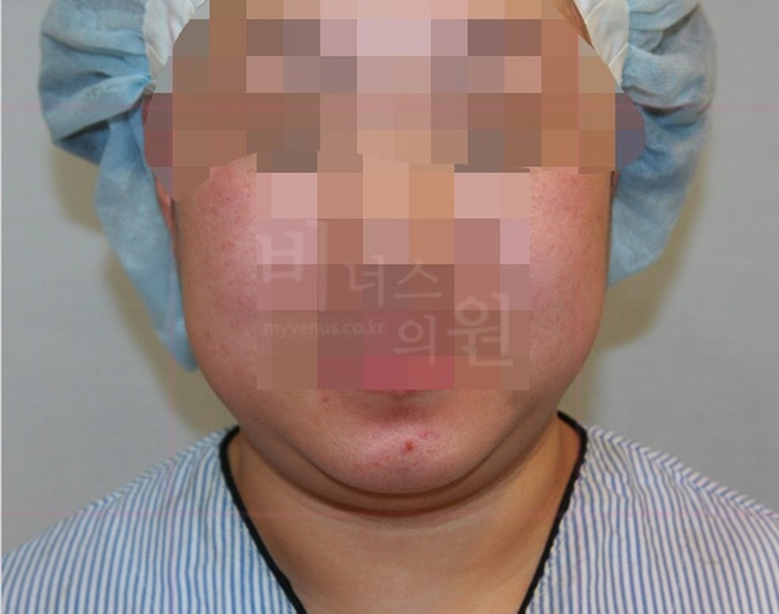 턱 지방흡입 수술 전 정면 사진