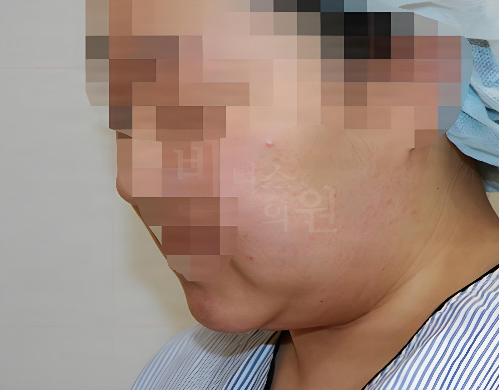 턱 지방흡입 수술 후 45도 측면 사진