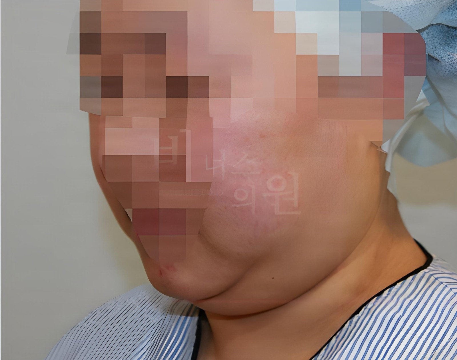 턱 지방흡입 수술 전 45도 측면 사진