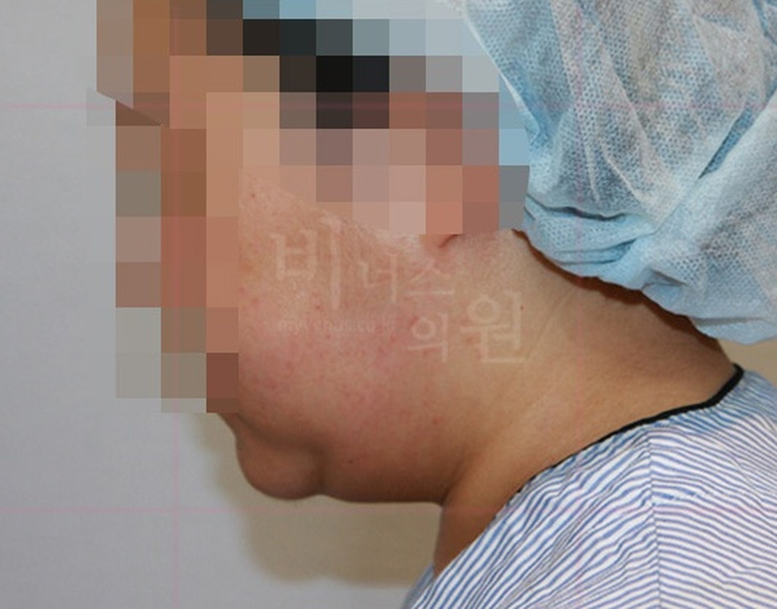 턱 지방흡입 수술 후 측면 사진