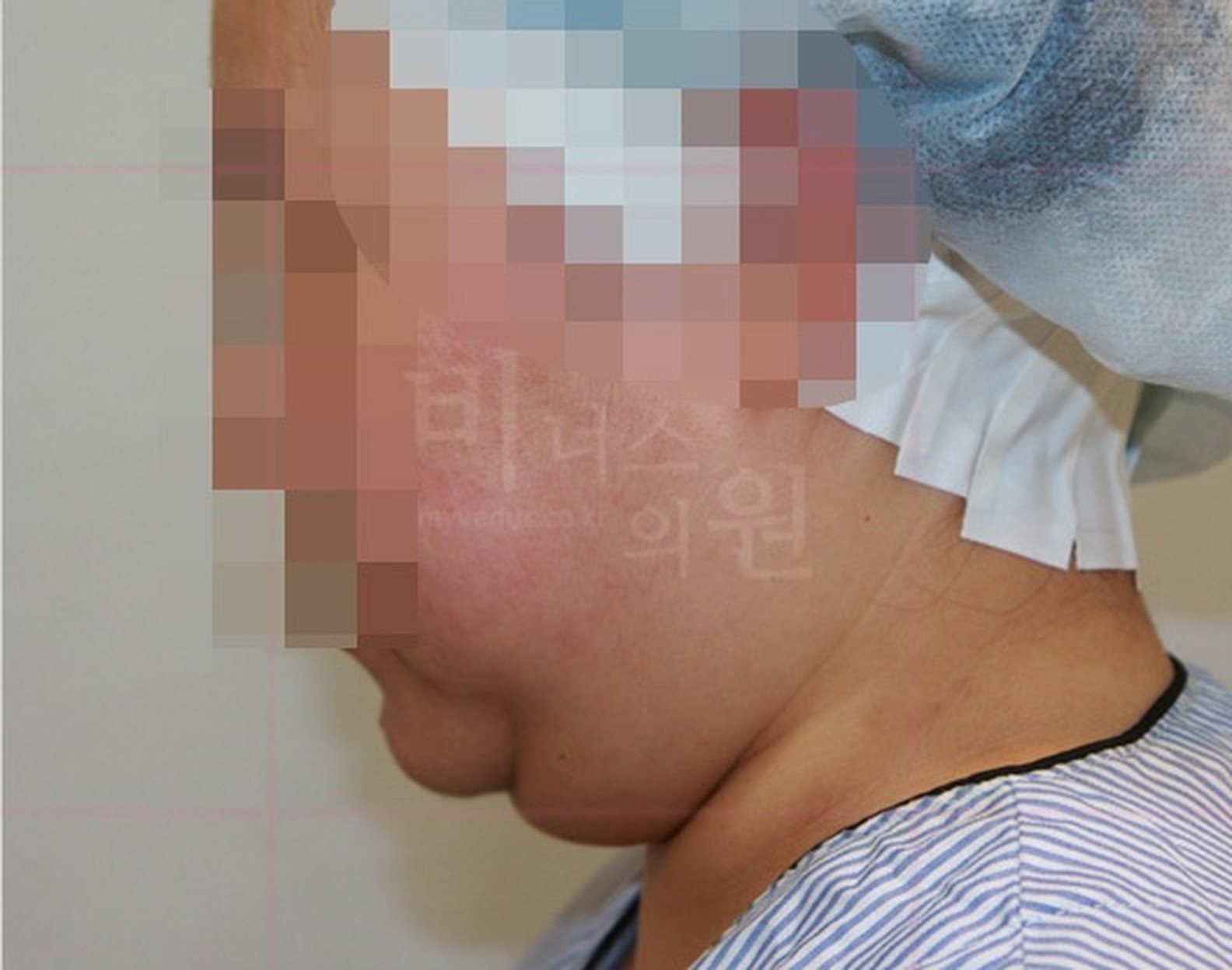 턱 지방흡입 수술 전 측면 사진
