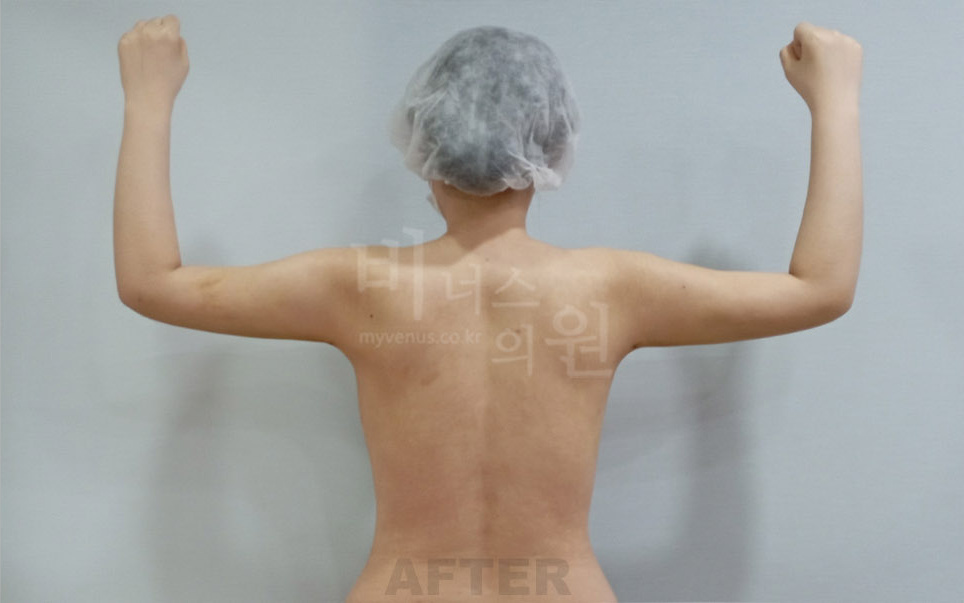 팔 지방흡입 후면 팔 올림 수술 후