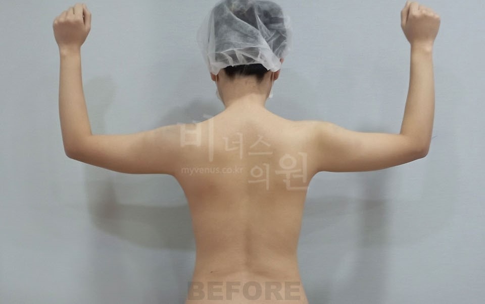 팔뚝지방흡입 사례 후면(팔 올림) 수술 전 — 2025년 촬영, 부천 비너스의원