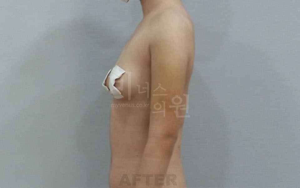 팔뚝지방흡입 사례 우측면 수술 후 — 2025년 촬영, 부천 비너스의원