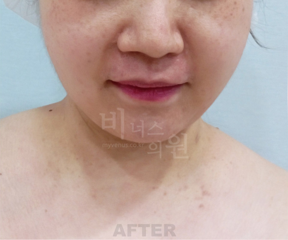 이중턱·목 지방흡입 사례 정면 — 수술 후 (부천 비너스의원)