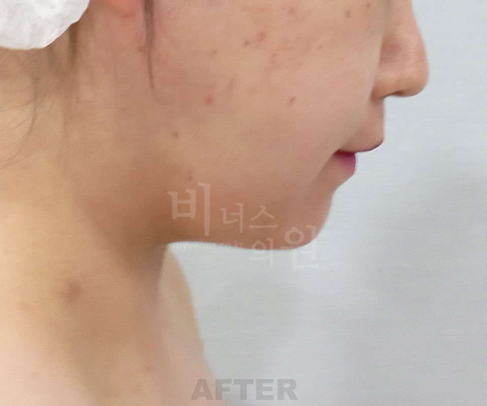 이중턱·목 지방흡입 사례 측면② — 수술 후 (부천 비너스의원)