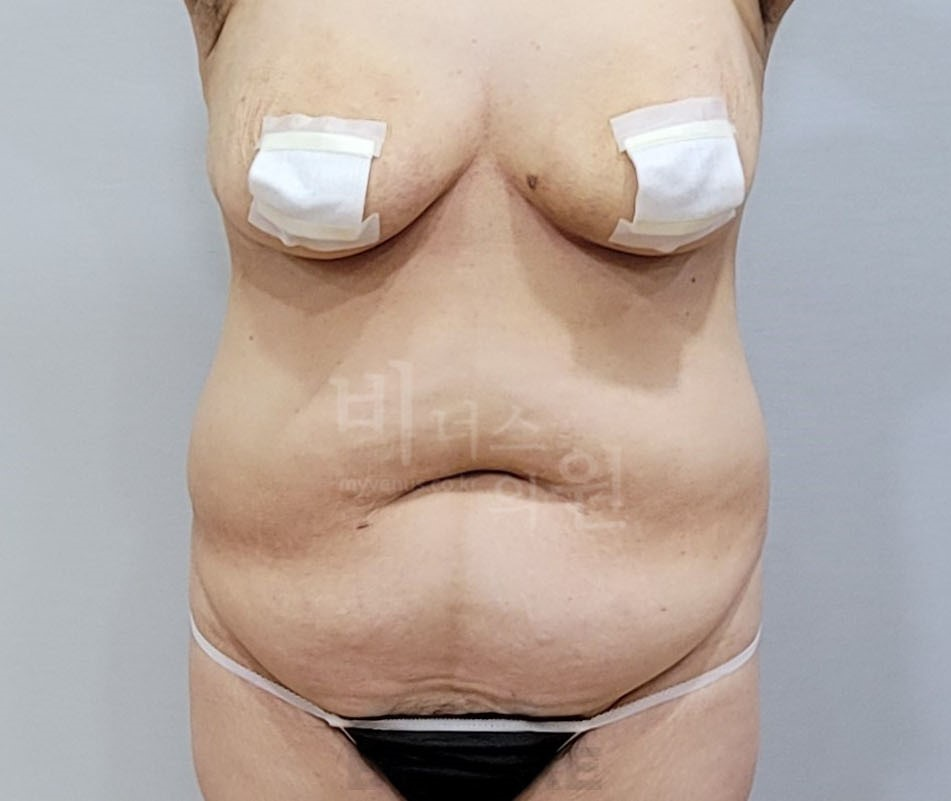 복부 수술 전 정면 사진 (2026년 촬영)