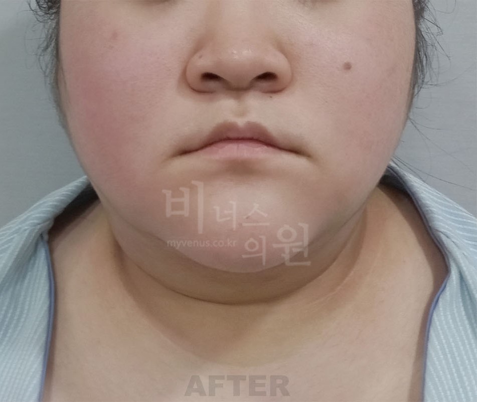 수술 후 정면 — 턱선·얼굴 아래쪽 윤곽 전후 비교