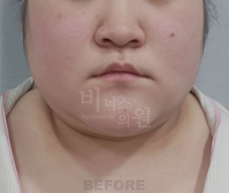 수술 전 정면 — 턱선·얼굴 아래쪽 윤곽 전후 비교