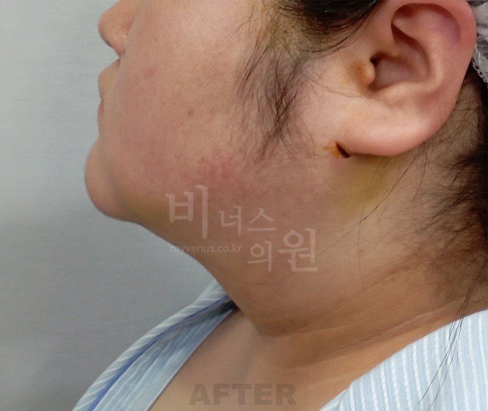 수술 후 측면① — 턱 끝에서 목으로 이어지는 윤곽