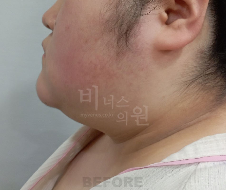 수술 전 측면① — 턱 끝에서 목으로 이어지는 윤곽
