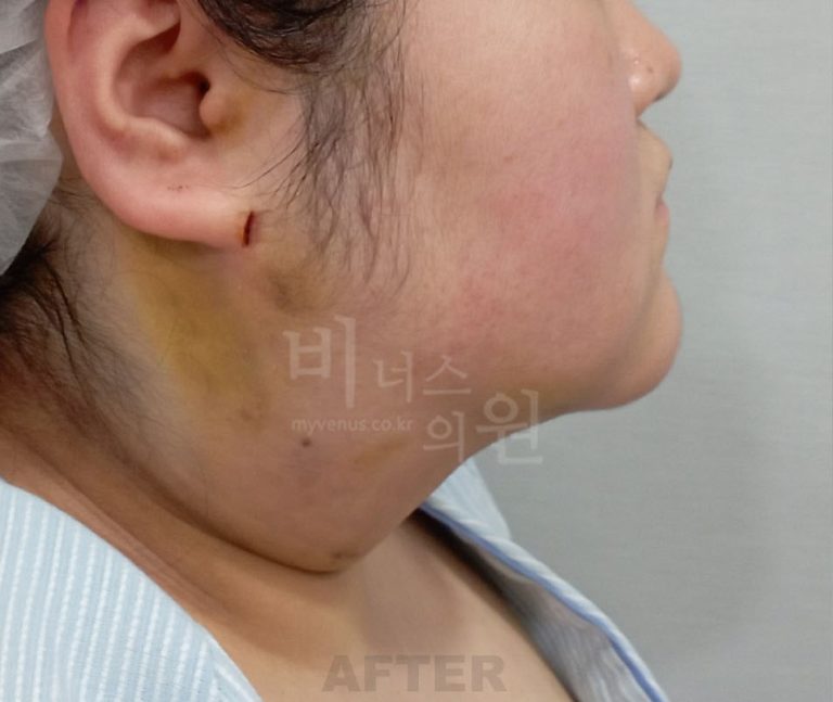 수술 후 측면②(반대 방향) — 턱 아래·목 윤곽
