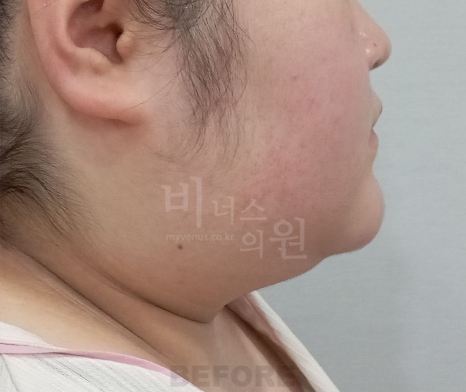 수술 전 측면②(반대 방향) — 턱 아래·목 윤곽