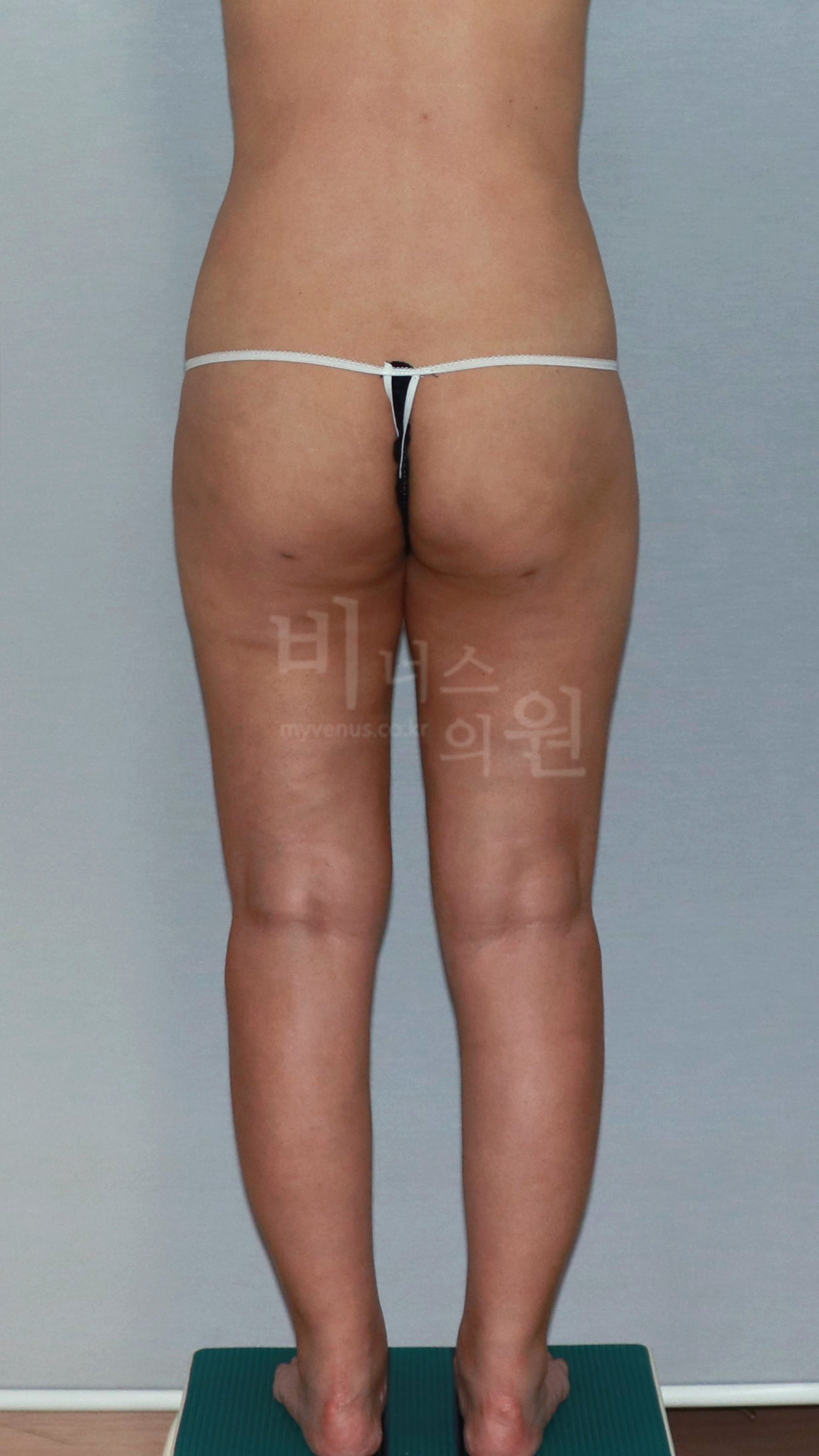 엉덩이 지방흡입 후면 사례 사진 4 — 2018년 촬영 (부천 비너스의원)