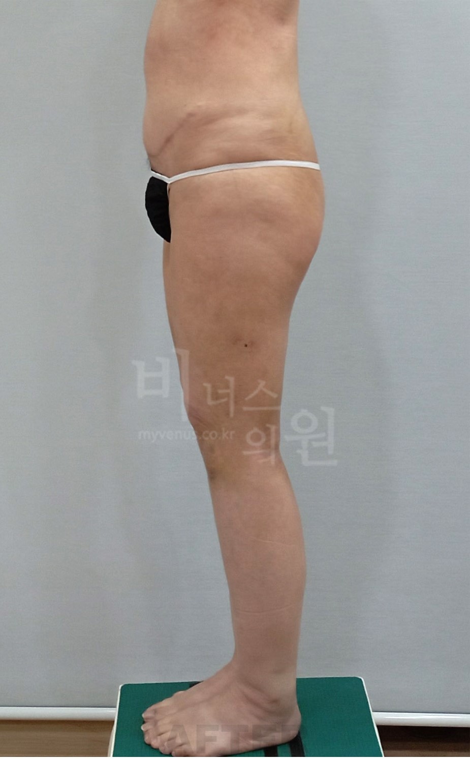 허벅지지방흡입 좌측면 수술 후 (2024년 촬영)