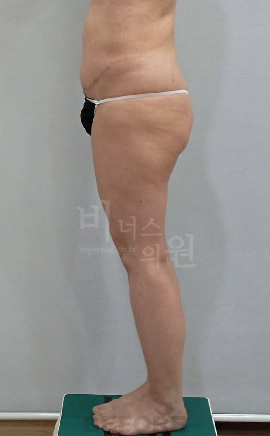 허벅지지방흡입 좌측면 수술 전 (2024년 촬영)