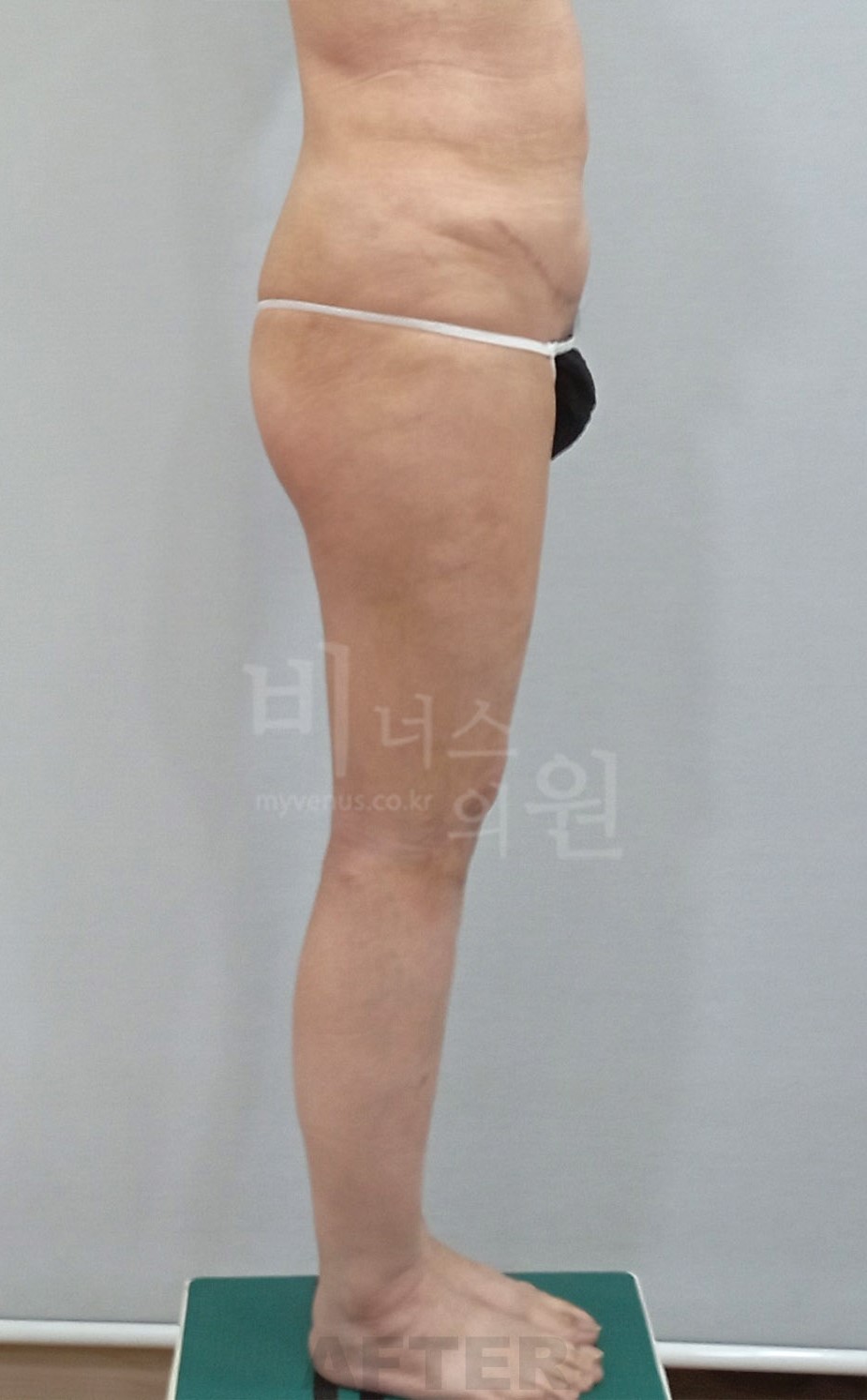 허벅지지방흡입 우측면 수술 후 (2024년 촬영)
