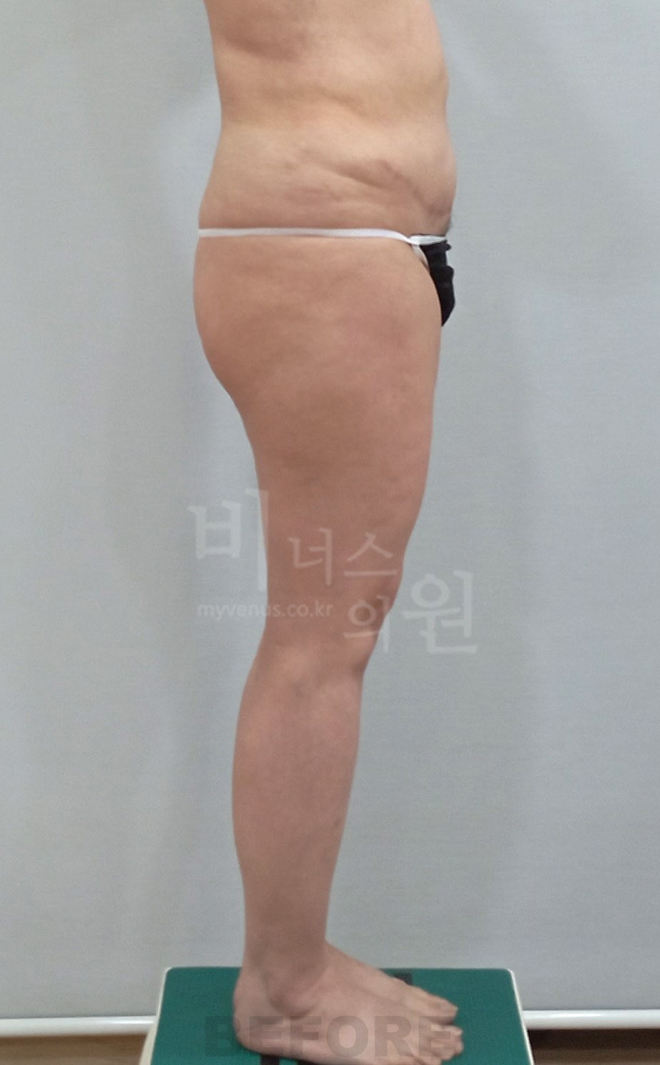 허벅지지방흡입 우측면 수술 전 (2024년 촬영)