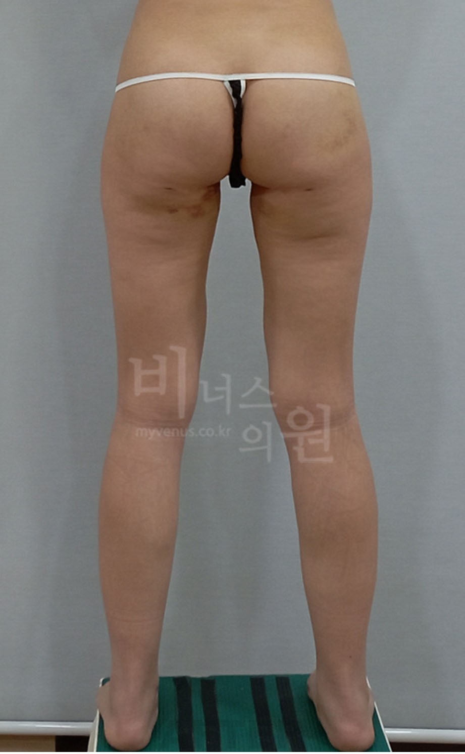 엉덩이 수술 후 후면 — 2025년 촬영 (부천 비너스의원)