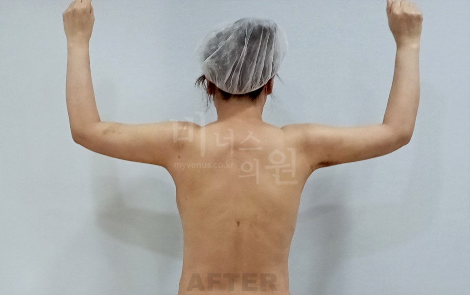 팔뚝지방흡입 후면, 두 팔을 위로 든 자세에서 수술 후