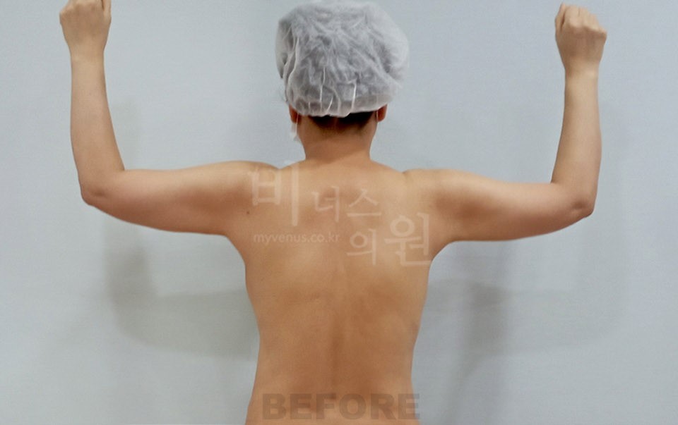 팔뚝지방흡입 후면, 두 팔을 위로 든 자세에서 수술 전