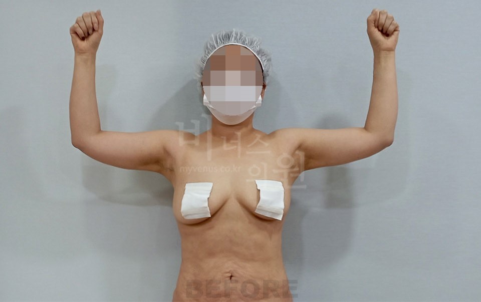 팔뚝지방흡입 정면, 두 팔을 위로 든 자세에서 수술 전