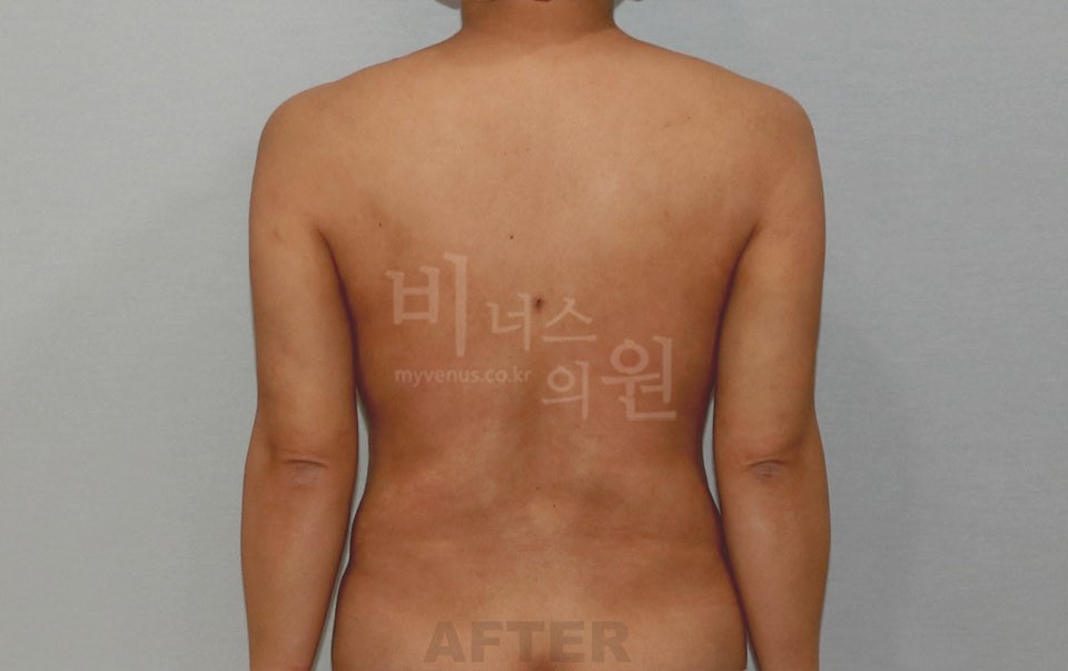 팔뚝지방흡입 수술 후 후면 팔 내림 — 2021년 촬영