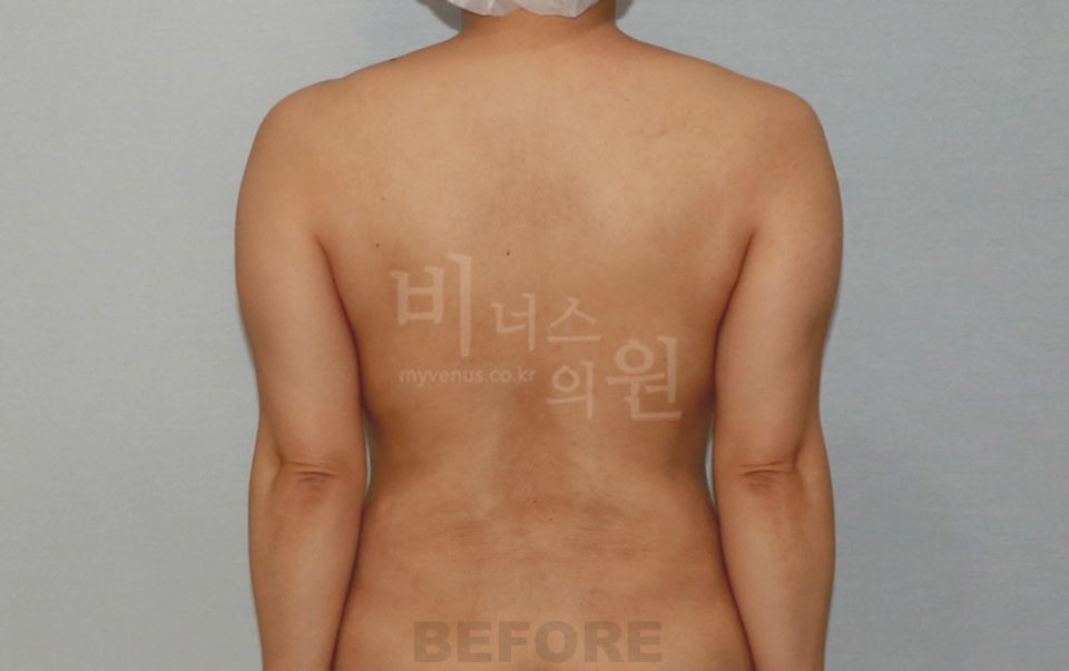 팔뚝지방흡입 수술 전 후면 팔 내림 — 2021년 촬영