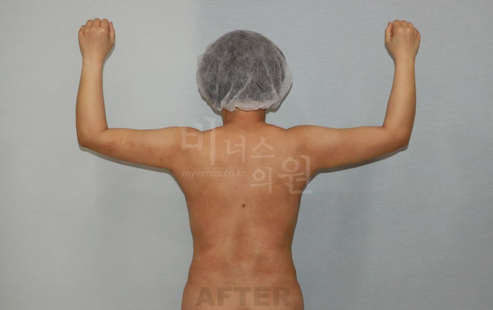 팔뚝지방흡입 수술 후 후면 팔 올림 — 2021년 촬영