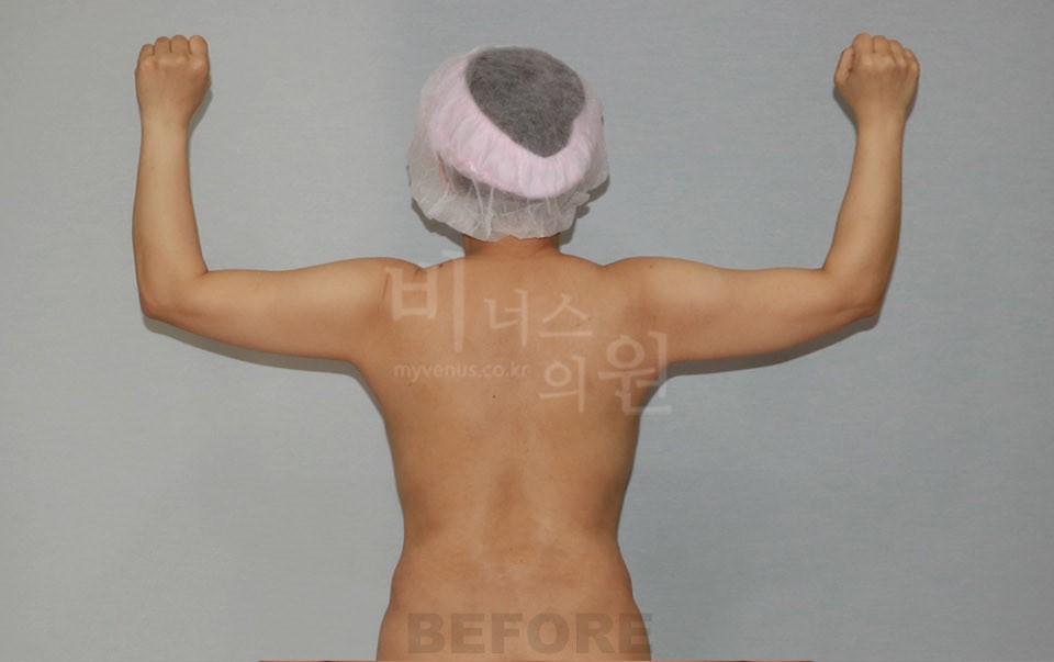 팔뚝지방흡입 수술 전 후면 팔 올림 — 2021년 촬영