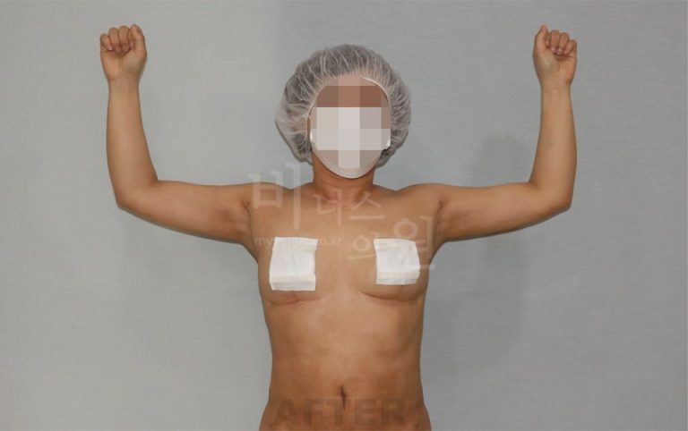 팔뚝지방흡입 수술 후 정면 팔 올림 — 2021년 촬영