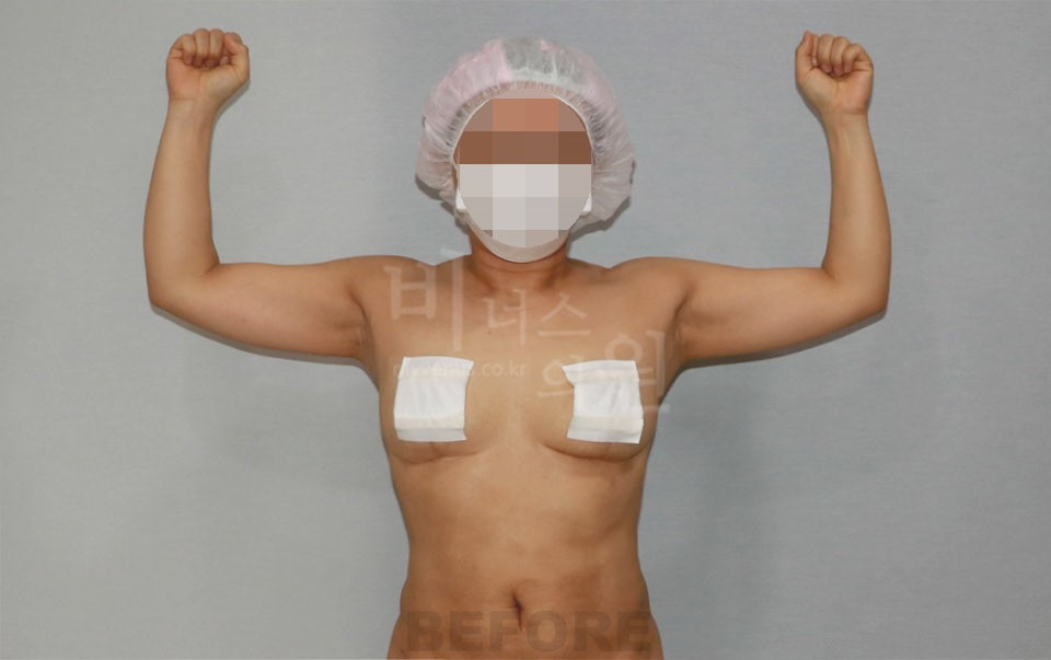팔뚝지방흡입 수술 전 정면 팔 올림 — 2021년 촬영
