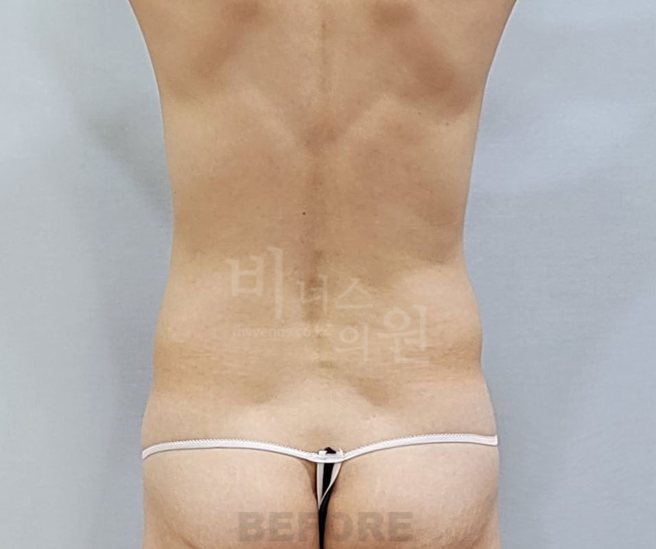 첫 복부 지방흡입 수술 사례 수술 전 후면, 2026년 촬영