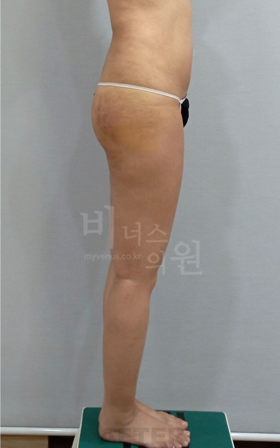 엉덩이 지방흡입 수술 후 우측면 — 2025년 촬영