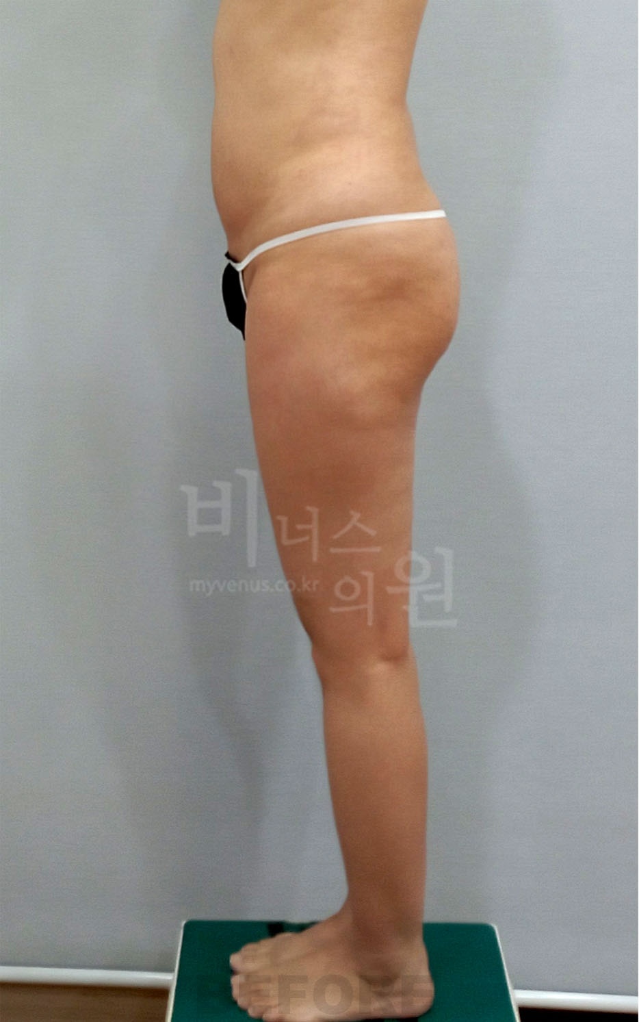 엉덩이 지방흡입 수술 전 좌측면 — 2025년 촬영