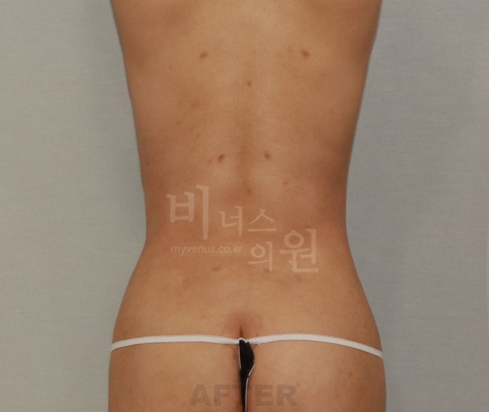 복부 지방흡입 수술 후 후면 사진