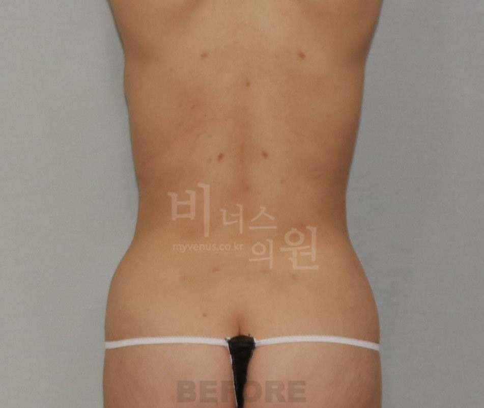 복부 지방흡입 수술 전 후면 사진