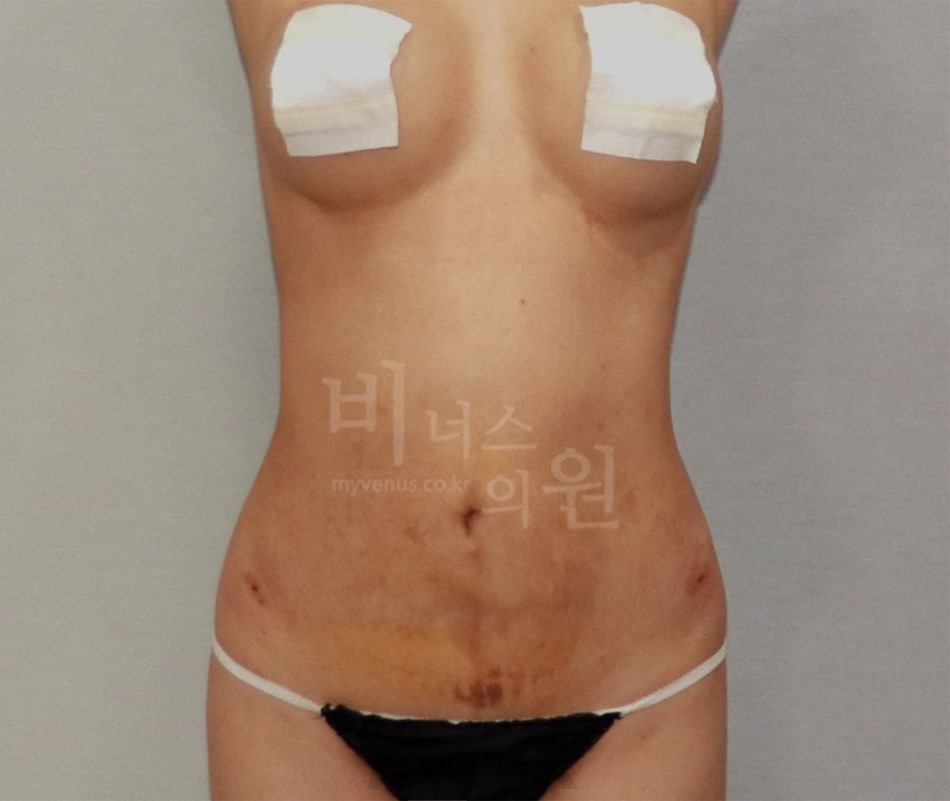 복부 지방흡입 수술 후 정면 사진