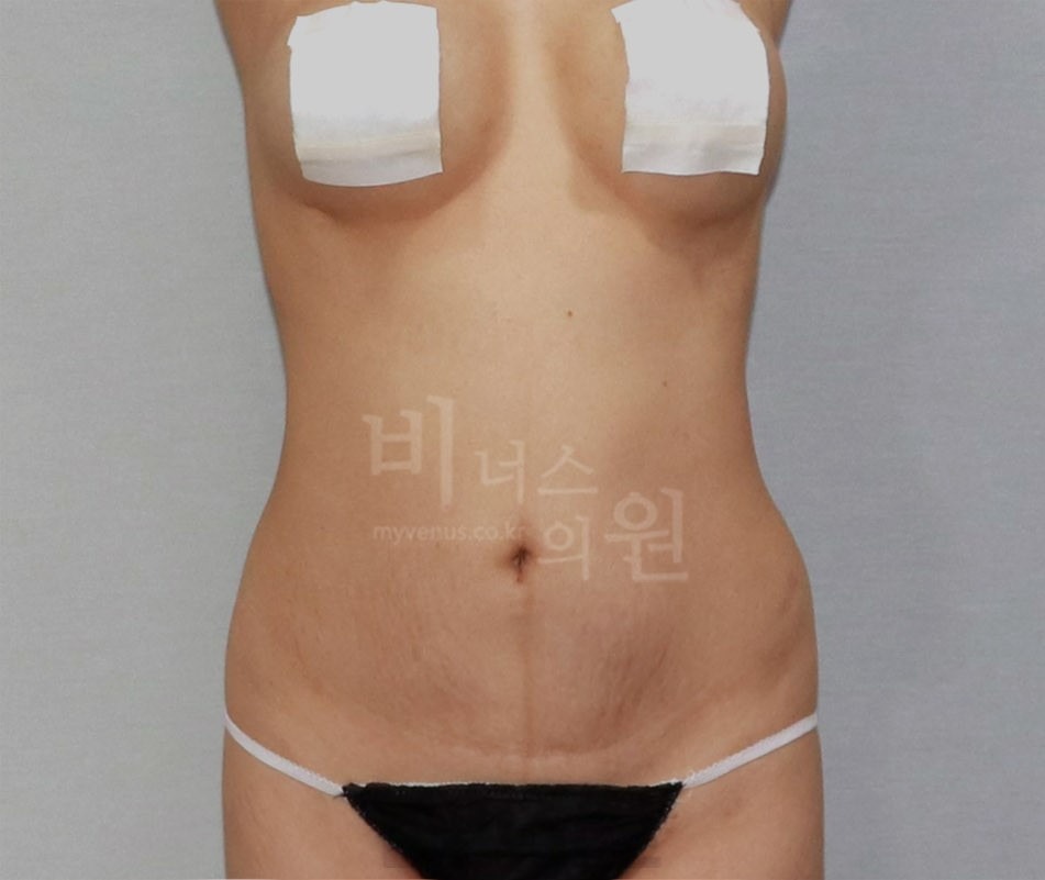 복부 지방흡입 수술 전 정면 사진