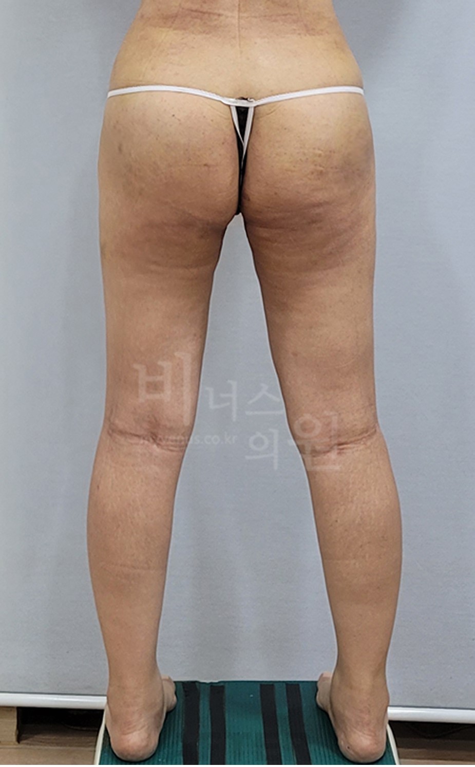 엉덩이 지방흡입 후면 수술 후 (2025년 촬영)