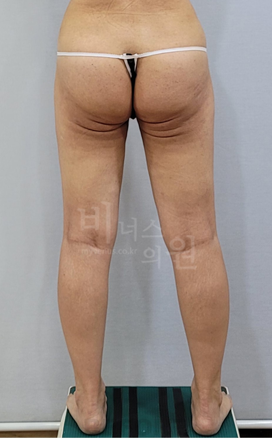 엉덩이 지방흡입 후면 수술 전 (2025년 촬영)