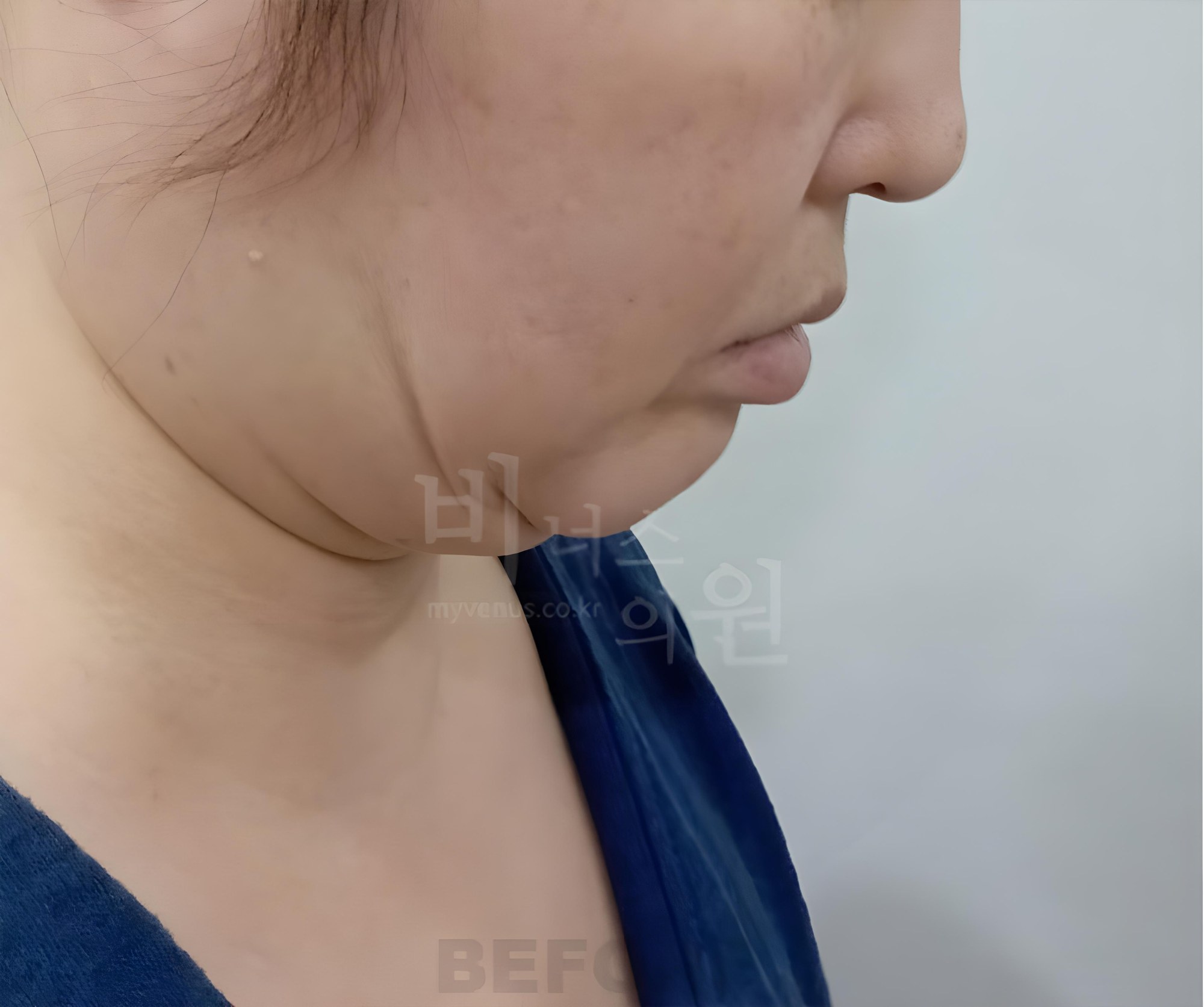 턱·이중턱 지방흡입 수술 전 고개를 숙인 측면 사진, 턱 아래 피부 접힘 (부천 비너스의원)