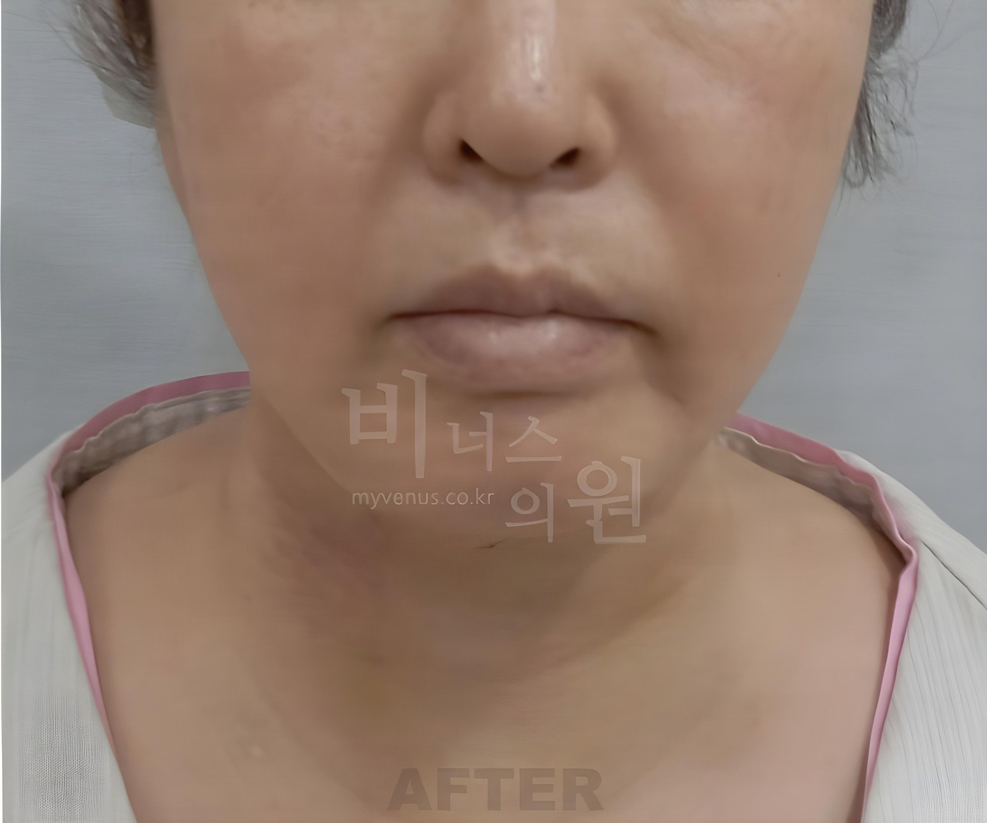 턱·이중턱 지방흡입 수술 후 정면 사진 (부천 비너스의원)