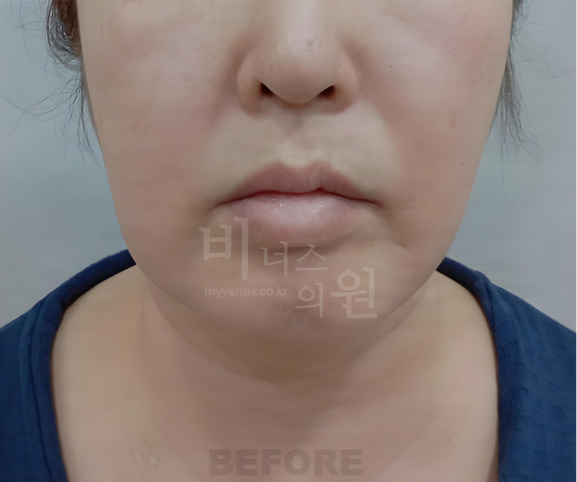 턱·이중턱 지방흡입 수술 전 정면 사진 (부천 비너스의원)