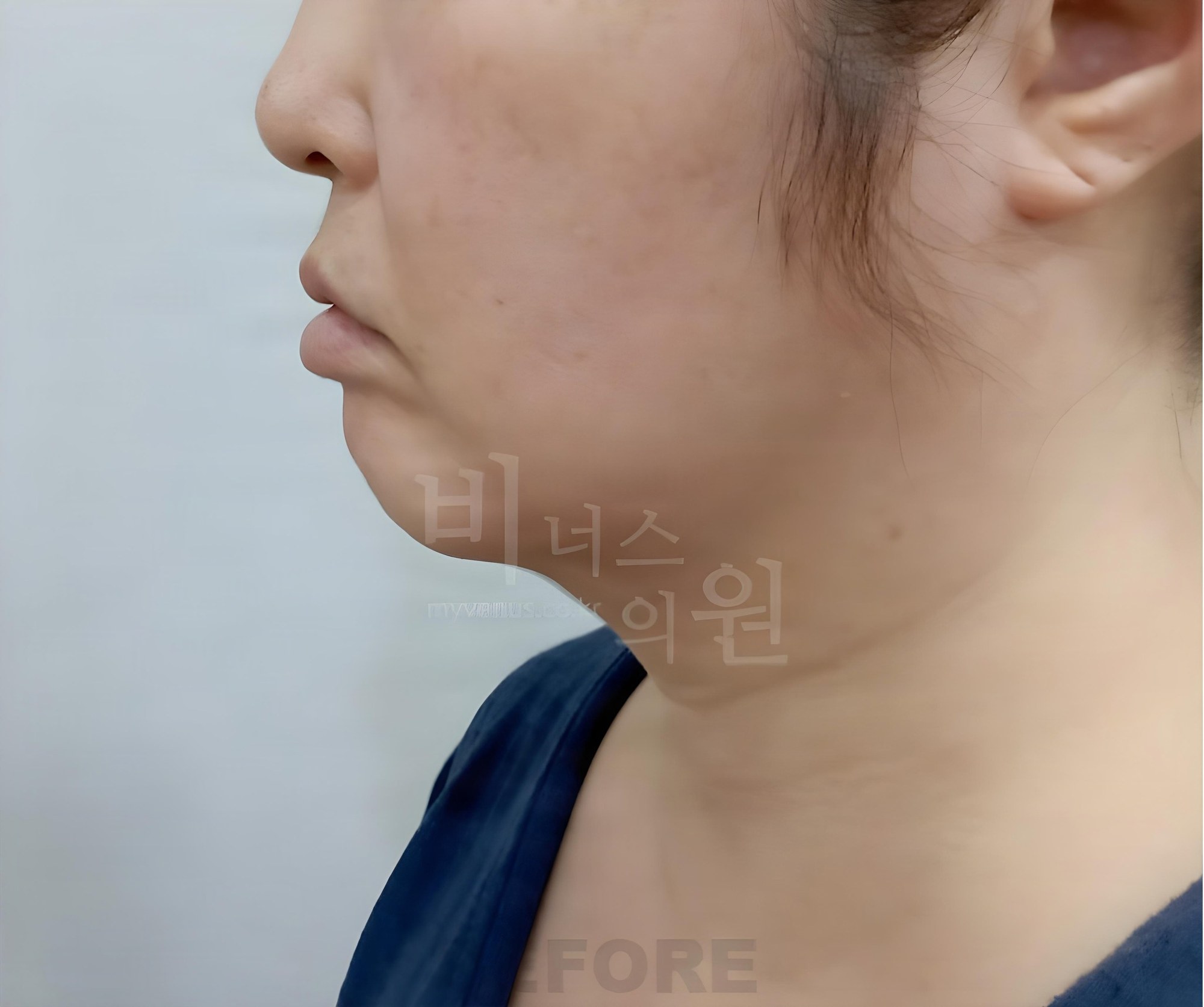 턱·이중턱 지방흡입 수술 전 측면 사진 (부천 비너스의원)