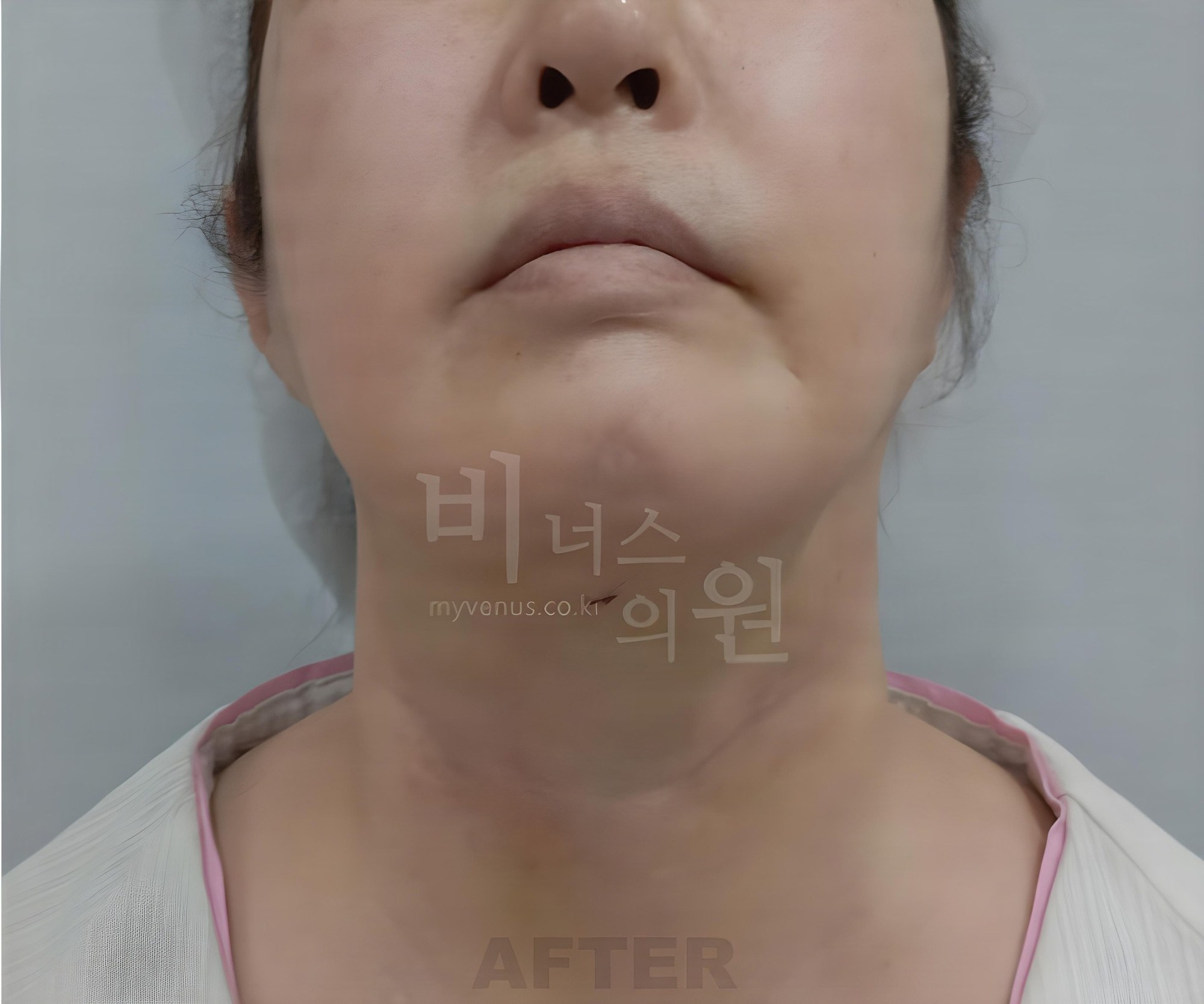 턱·이중턱 지방흡입 수술 후 턱을 든 정면 사진 (부천 비너스의원)