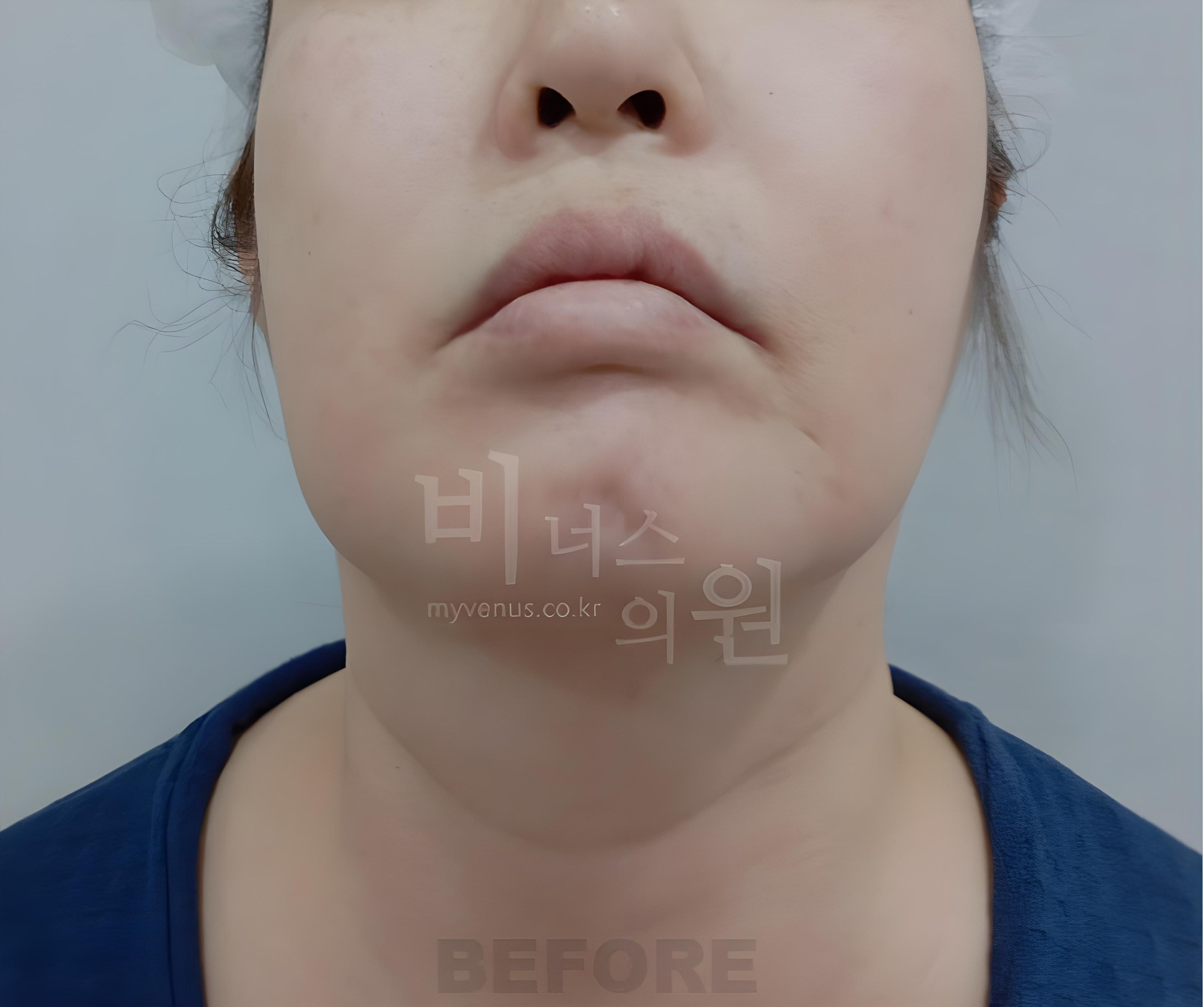 턱·이중턱 지방흡입 수술 전 턱을 든 정면 사진 (부천 비너스의원)