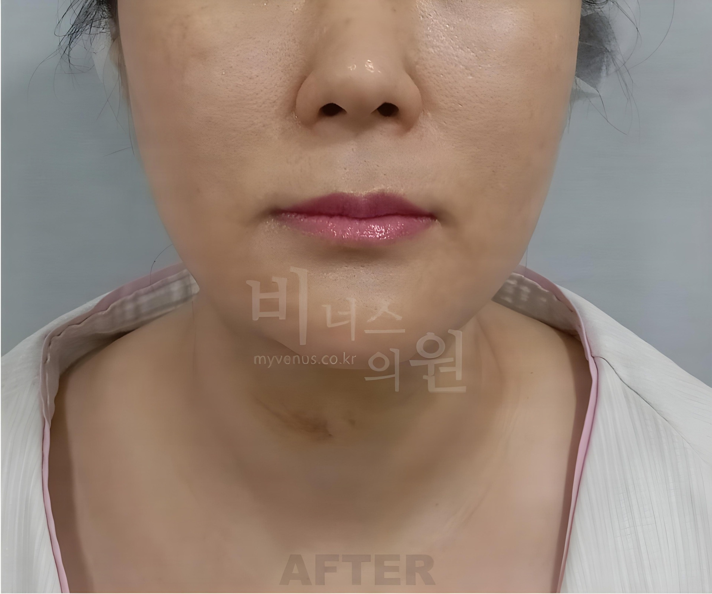 턱·이중턱 지방흡입 수술 후 정면 사진 (2026년 촬영, 부천 비너스의원)