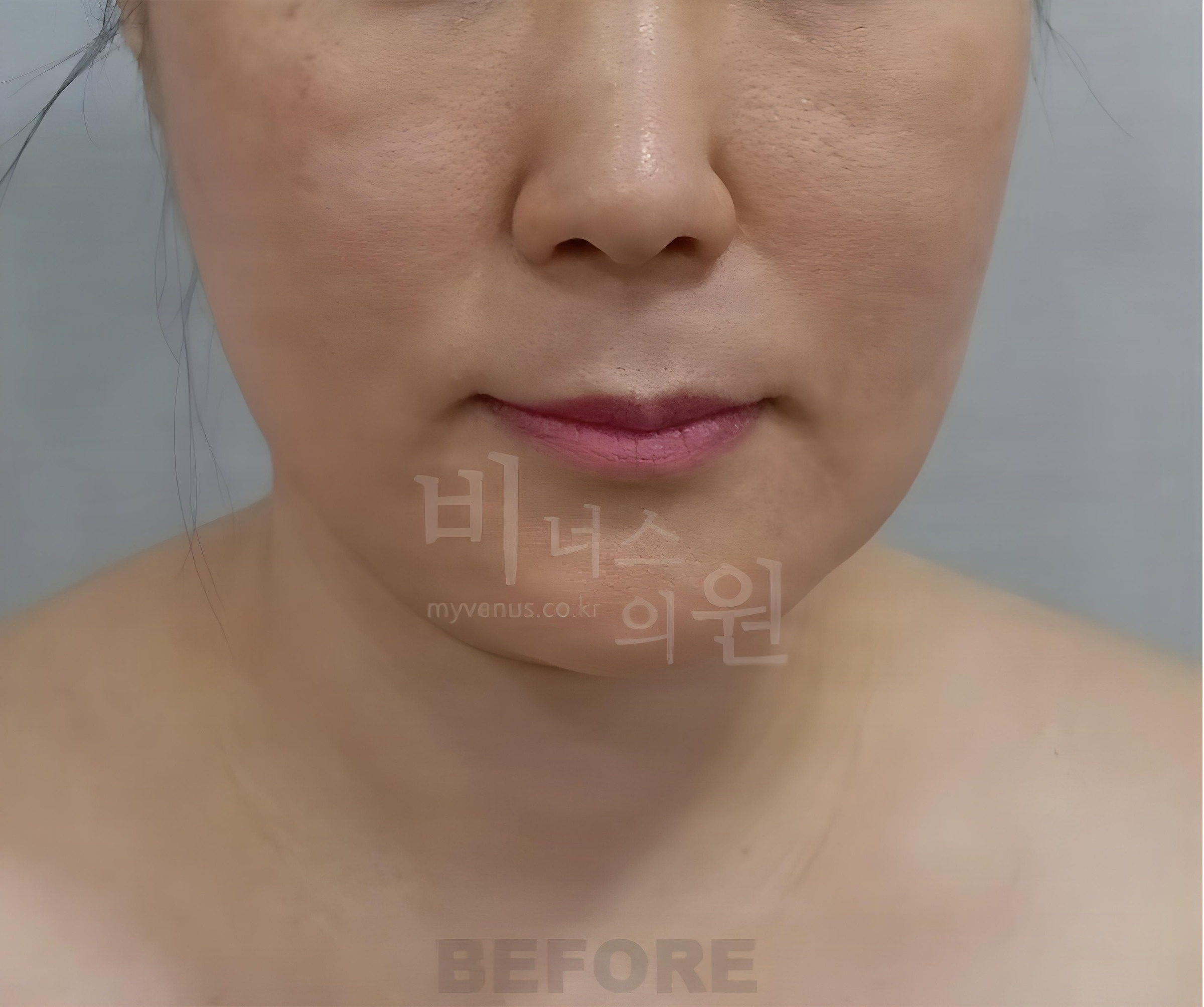턱·이중턱 지방흡입 수술 전 정면 사진 (2026년 촬영, 부천 비너스의원)