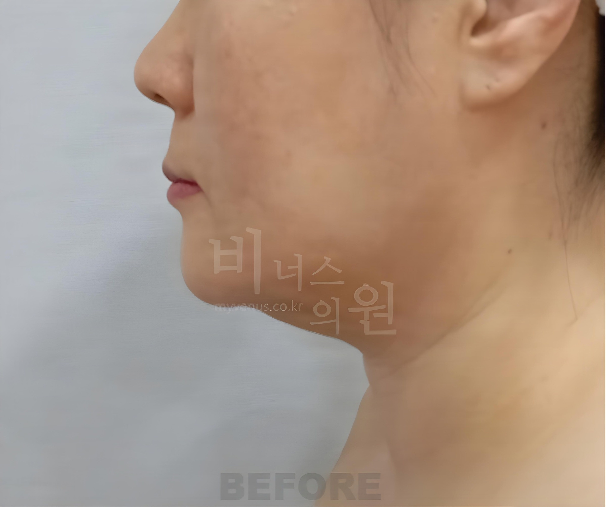 턱·이중턱 지방흡입 수술 전 왼쪽 측면 사진 (부천 비너스의원)